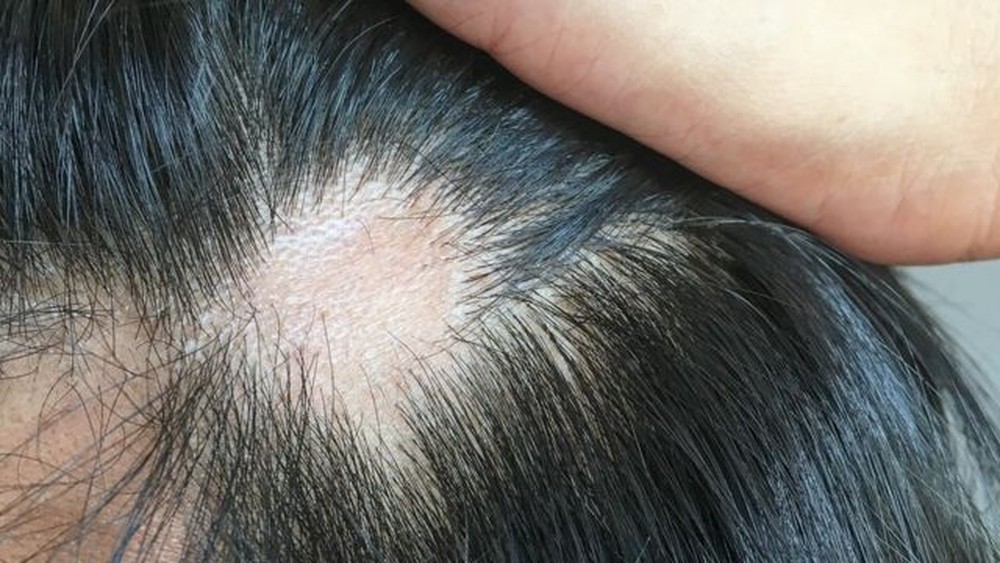 Estudos acadêmicos abordam a ligação entre a queda de cabelo acentuada e Covid-19, mas as causas, a duração e os tratamentos ainda não estão muito claros.